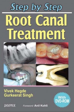 STEP BY STEP ROOT CANAL TREATMENT PDF